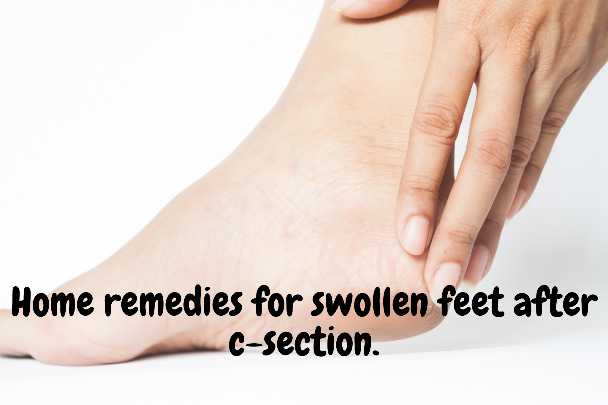 Home remedies for swollen feet after c-section.