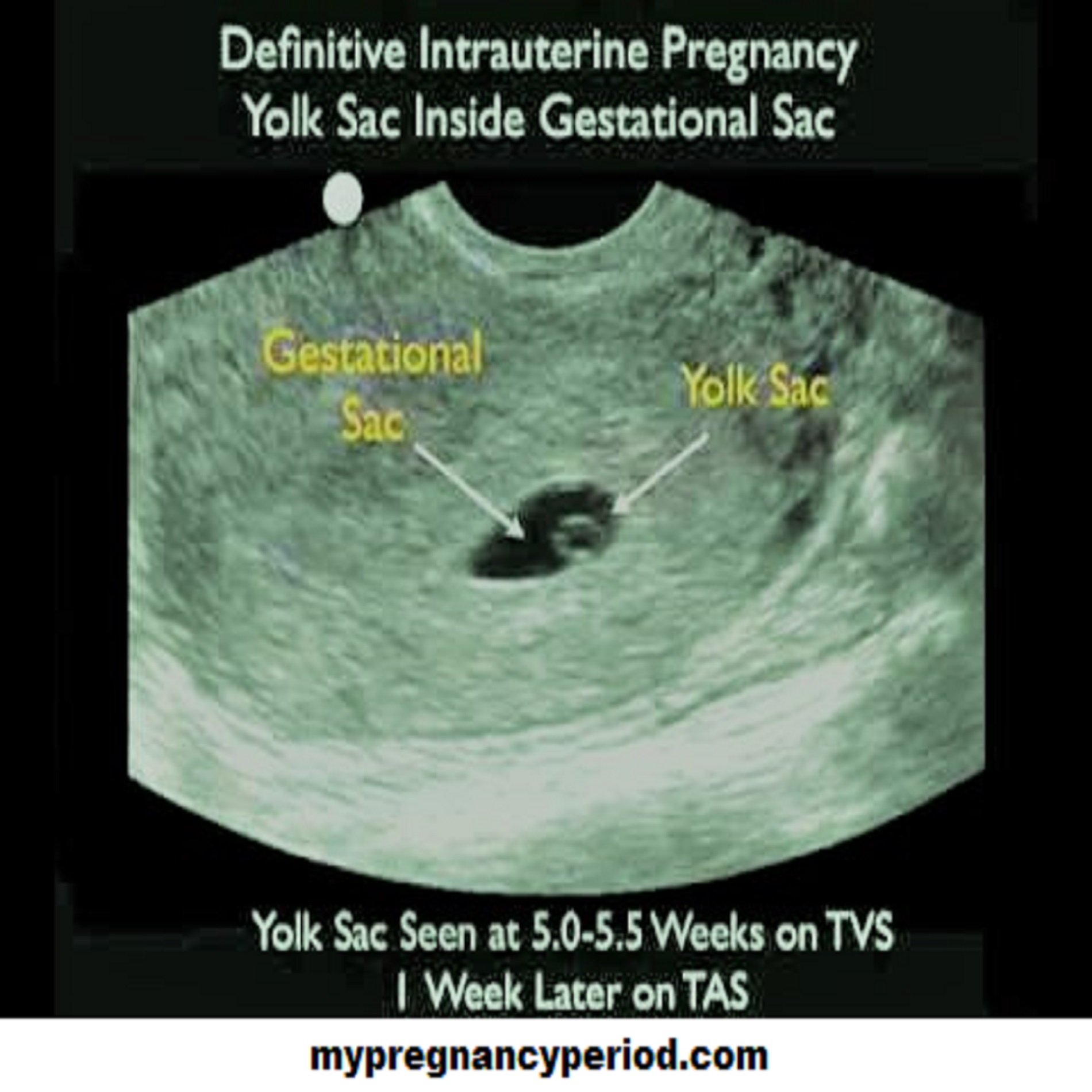 ultrasound view of Intrauterine Pregnancy IUP