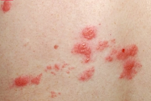 allergy during pregnancy